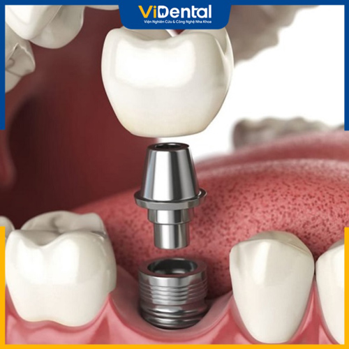 Cấy ghép implant là phương pháp phục hình răng đã mất được áp dụng nhiều nhất hiện nay