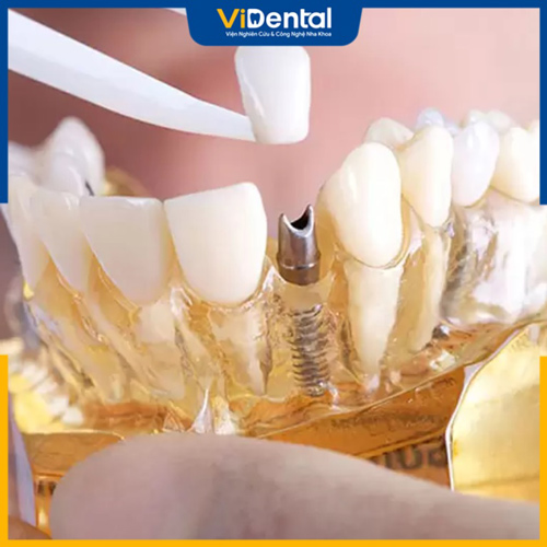 Chi phí phục hình răng phụ thuộc vào nhiều yếu tố