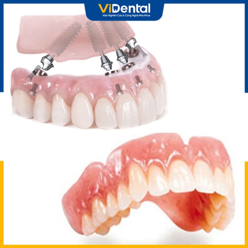 Hàm tháo lắp và implant là 2 phương pháp trồng răng nguyên hàm