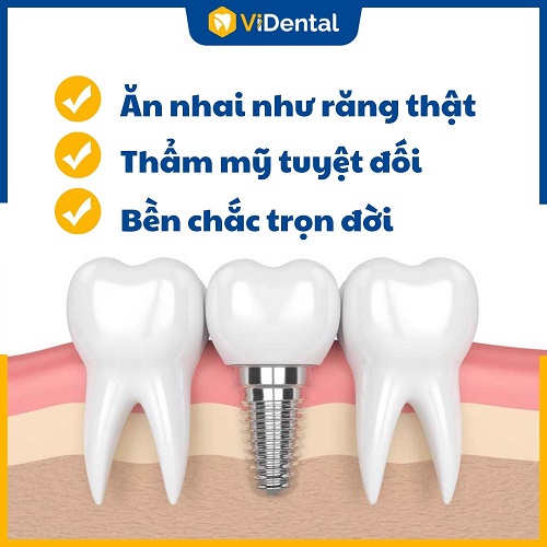 Implant là giải pháp trồng răng tối ưu nhất hiện nay