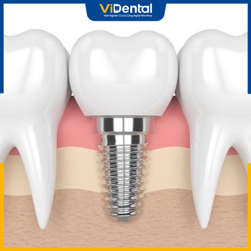 Trồng răng gần như không đau nếu đúng kỹ thuật và được tiêm thuốc tê