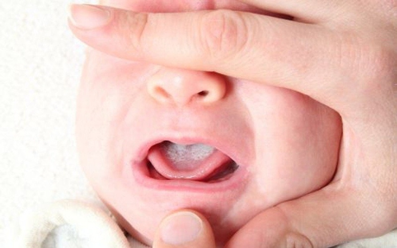 Trẻ 3 tuổi bị sưng nướu răng do nhiều nguyên nhân khác nhau