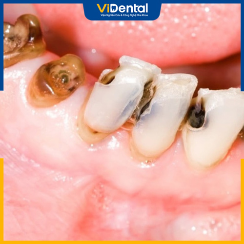 Sâu răng là bệnh lý răng miệng phổ biến