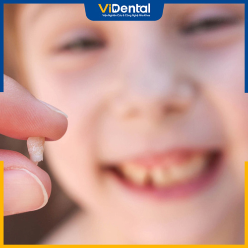 Sâu răng không xử lý kịp thời có thể khiến trẻ bị mất răng