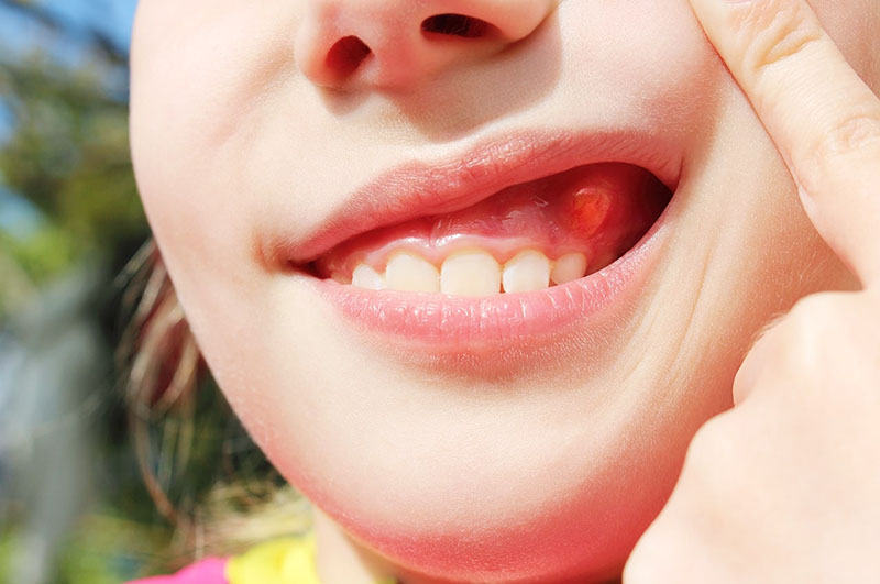 Bé bị nổi mụn ở nướu răng có thể xuất phát từ nhiều nguyên nhân khác nhau