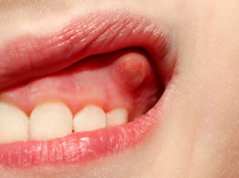 Hiện tượng nướu nổi mụn là dấu hiệu cảnh báo nhiều bệnh lý răng miệng nguy hiểm