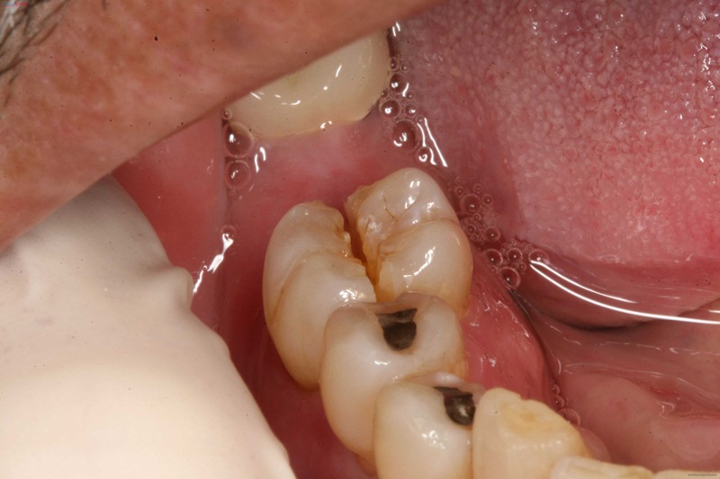 Nhiều nguyên nhân khiến bé bị sâu răng cấm 