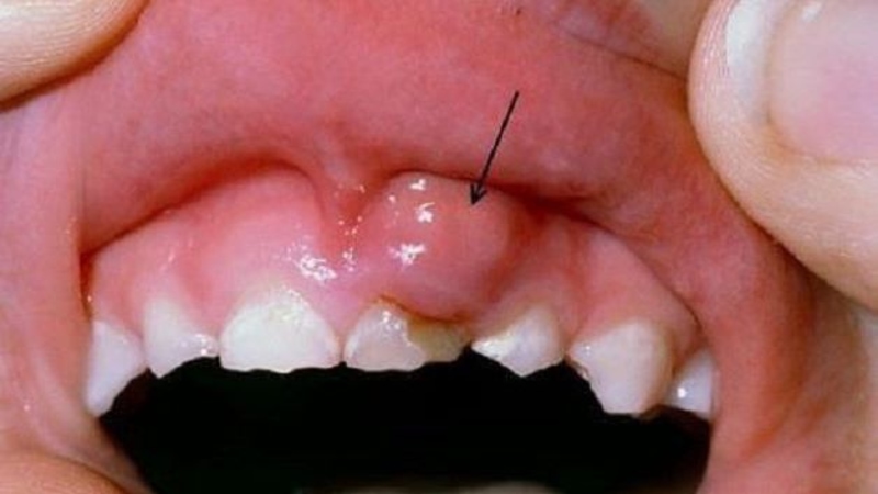 Bé bị viêm chân răng bắt nguồn từ nhiều nguyên nhân khác nhau