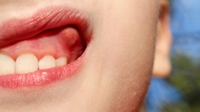 Các mảng bám trên răng là nguyên nhân chính khiến trẻ bị viêm nướu hôi miệng