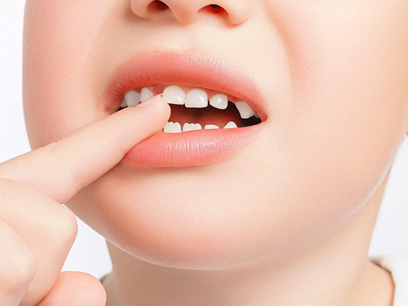 Răng cửa của bé lâu mọc lại ảnh hưởng nghiêm trọng đến sức khỏe răng miệng của bé
