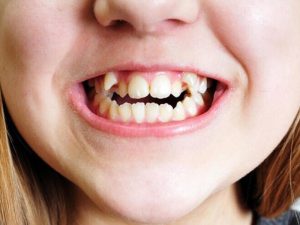 [Xem ngay] Những Dấu Hiệu Mọc Răng Khểnh Ở Trẻ Bạn Cần Biết