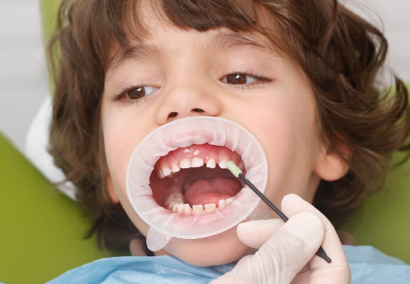 Hàn răng trẻ em có an toàn và hiệu quả không là băn khoăn của phụ huynh