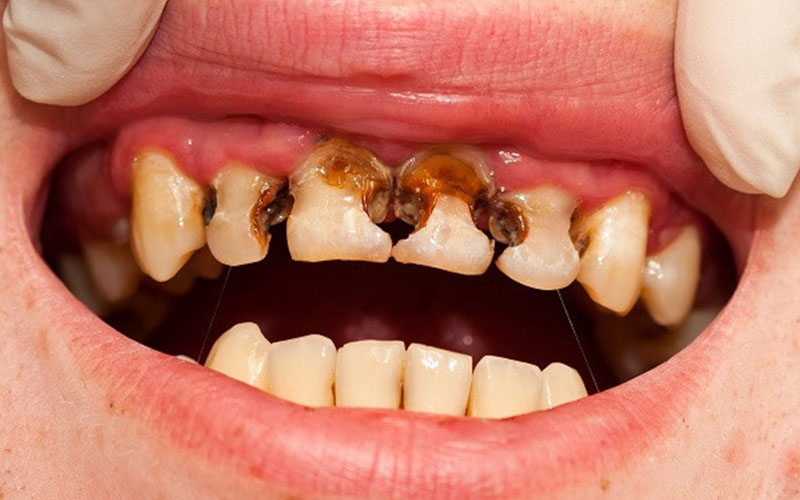 Răng vĩnh viễn của bé bị sâu khiến nhiều cha mẹ lo lắng