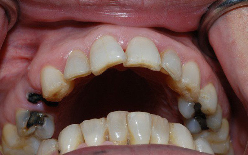 Răng hàm nhỏ của bé bị sâu làm ảnh hưởng tới chức năng ăn nhai