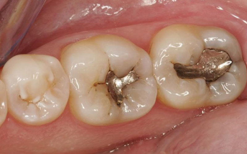 Răng hàm lớn dễ bị sâu do việc vệ sinh khó khăn hơn các răng còn lại