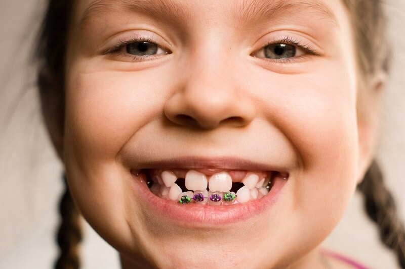 Phương pháp niềng răng mắc cài cố định phù hợp với trẻ trong độ tuổi từ 12 – 16 tuổi