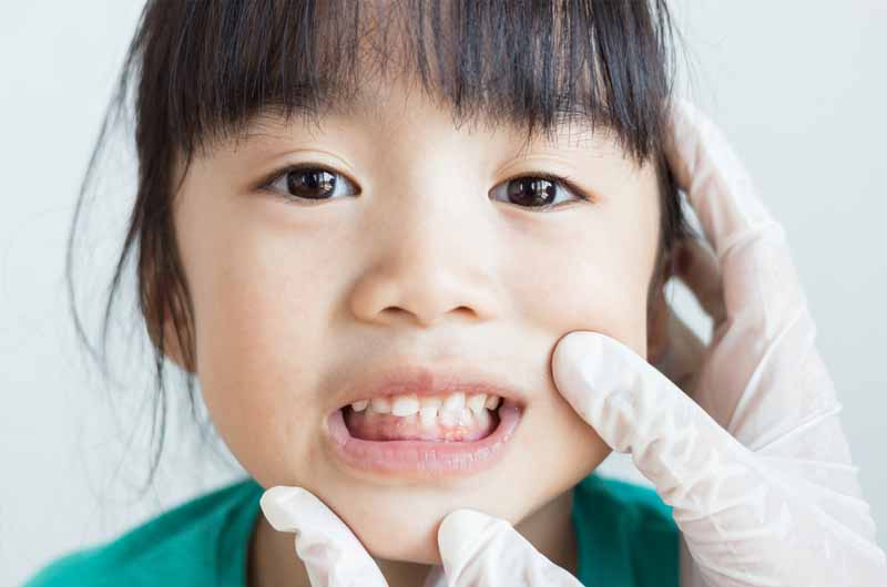Độ tuổi niềng răng có ảnh hưởng trực tiếp đến hiệu quả của phương pháp này