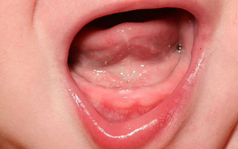 Nanh sữa ở trẻ sơ sinh là răng gì?