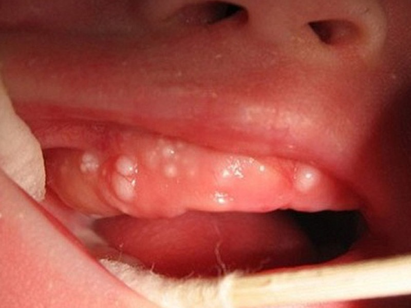 Những dấu hiện dễ nhận biết khi trẻ sơ sinh mọc răng
