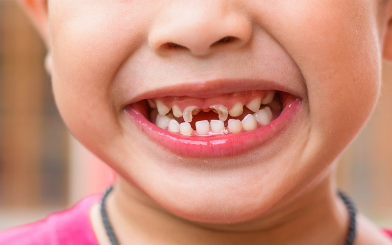 Một số nguyên nhân phổ biến gây ra tình trạng sâu răng ở trẻ
