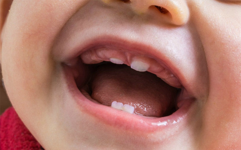 Giải đáp: Răng sữa là răng gì? 