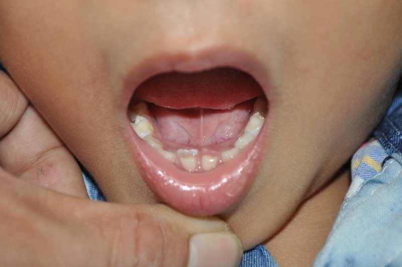 Một số thói quen xấu là nguyên nhân khiến răng trẻ chưa rụng răng mới đã mọc