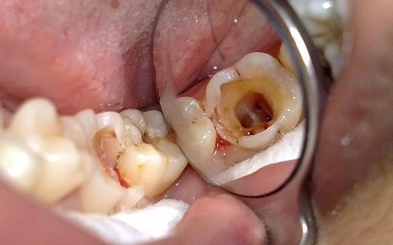 Các lỗ sâu rỗng hình thành ở trên răng 