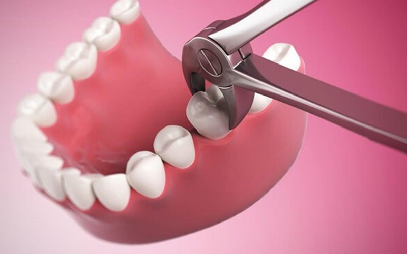 Nhổ răng được áp dụng với những trường hợp răng bị sâu nghiêm trọng