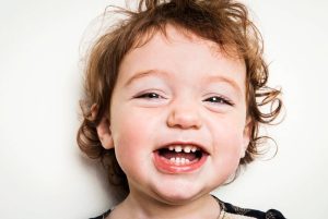 Sâu Răng Cửa Ở Trẻ Em: Nguyên Nhân, Dấu Hiệu Và Các Cách Điều Trị
