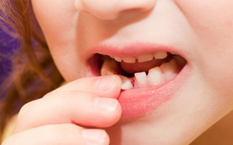Trong quá trình thay răng sữa, con thường gặp phải vấn đề gì? 