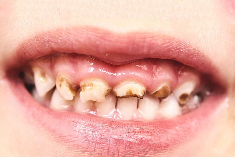Thông thường, trám răng là phương pháp thường được chỉ định nhất trong điều trị răng sâu