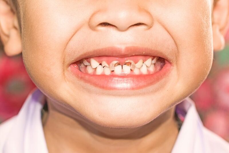 Trẻ 1 tuổi bị hư răng có thể xuất hiện các dấu hiệu như đốm đen, đau nhức, mùi hôi miệng