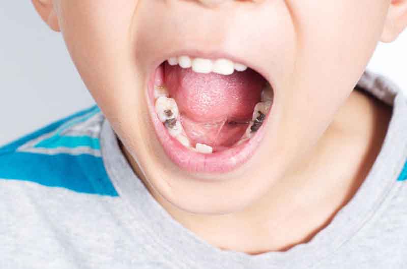 Nếu không được điều trị, xử lý kịp thời, tình trạng sâu răng ở trẻ sẽ dẫn tới nhiều vấn đề nghiêm trọng