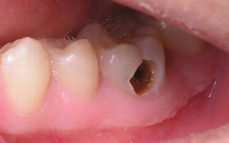 Trẻ bị sâu răng ăn vào tủy khiến nhiều cha mẹ lo lắng