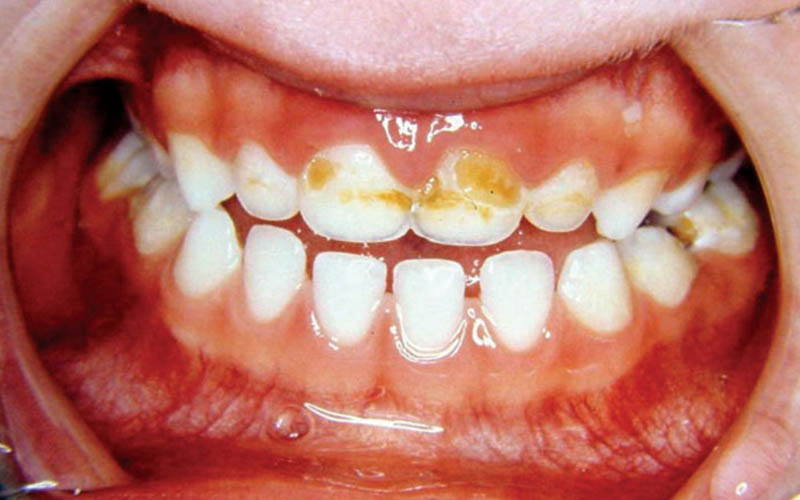 Sâu răng ở giai đoạn đầu thường khó phát hiện 
