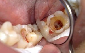 Trẻ Bị Sâu Răng Ăn Vào Tủy: Chuyên Gia Chẩn Đoán Và Điều Trị