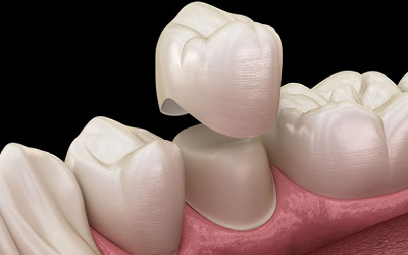 Bọc răng sứ giải quyết tình trạng sâu răng triệt để