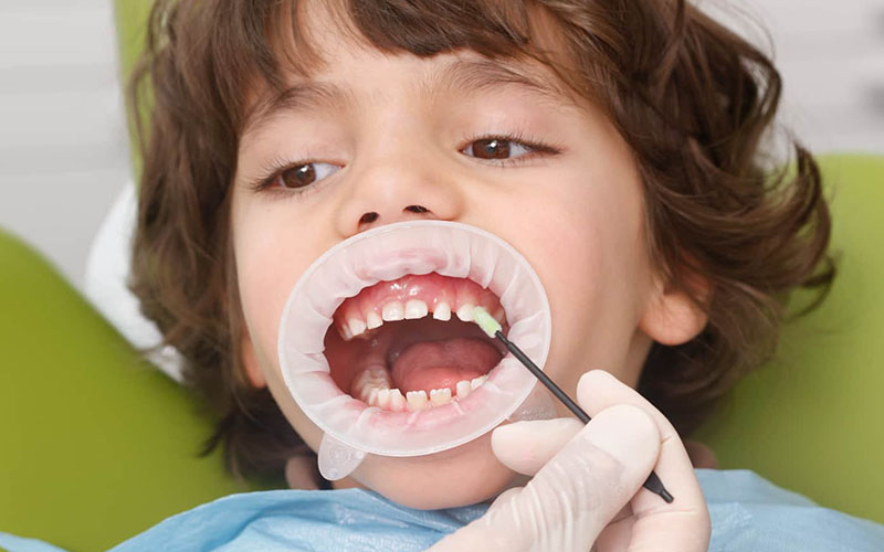 Trẻ bị sâu răng có nên nhổ bỏ hay không là băn khoăn của nhiều bậc cha mẹ