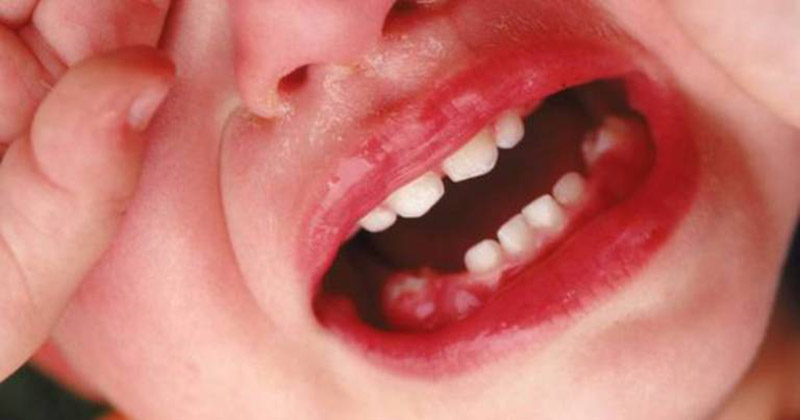Trẻ bị viêm lợi và sốt có thể do mọc răng