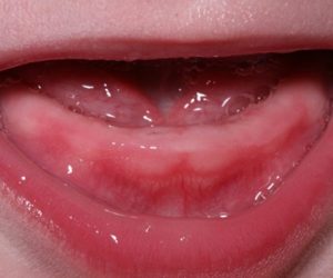 Trẻ Bị Viêm Lợi Khi Mọc Răng: Một Số Thông Tin Quan Trọng Nhất