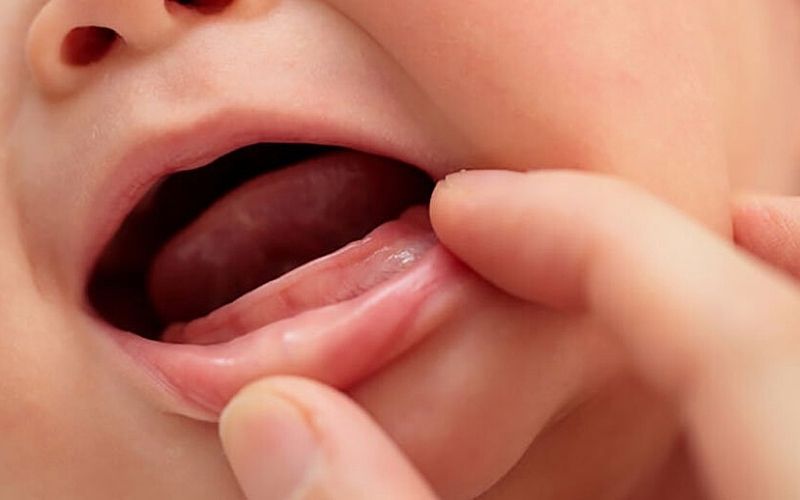 Trẻ chậm mọc răng thường khiến nhiều cha mẹ băn khoăn