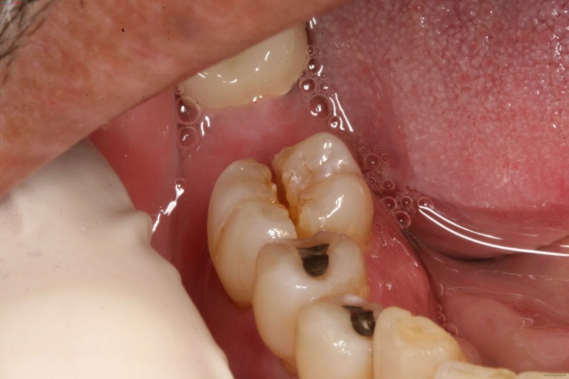 Trẻ bị sâu răng hàm thường xuất hiện cơn đau, ê buốt