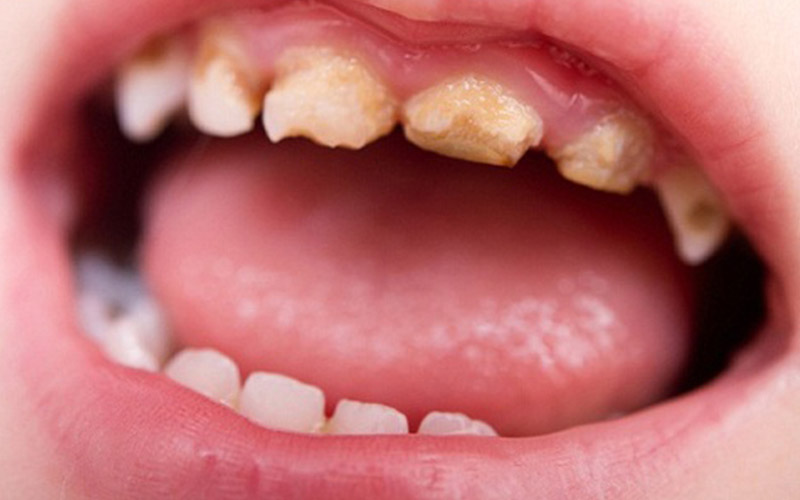 Cao răng làm gia tăng nguy cơ sâu răng ở trẻ