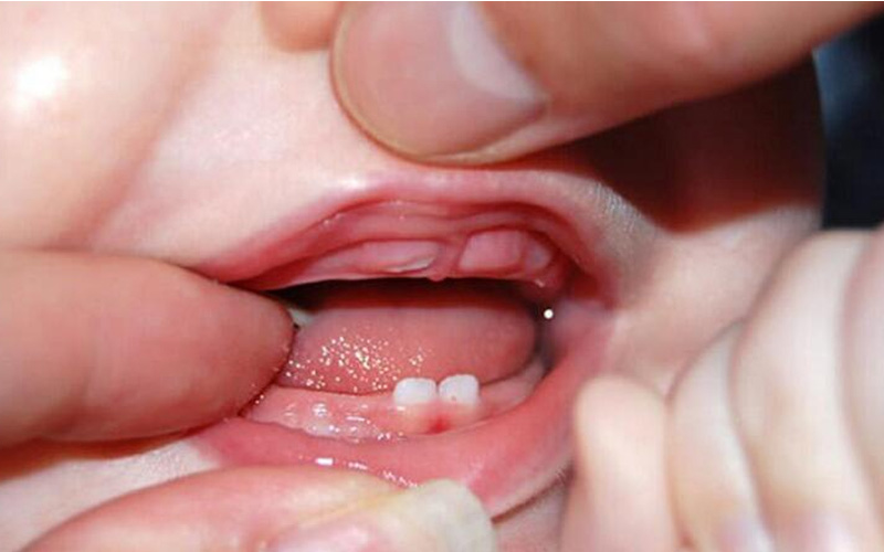 Những biểu hiện bố mẹ cần lưu ý khi trẻ mọc răng cấm 