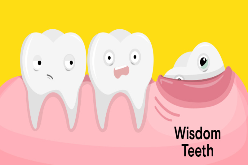 Trẻ mọc răng khôn thường sẽ gây đau nhức, khó chịu và ảnh hưởng tới sinh hoạt