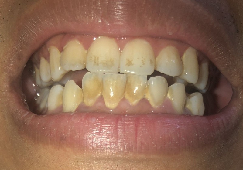 Trẻ mới mọc răng đã bị vàng là tình trạng khá phổ biến 