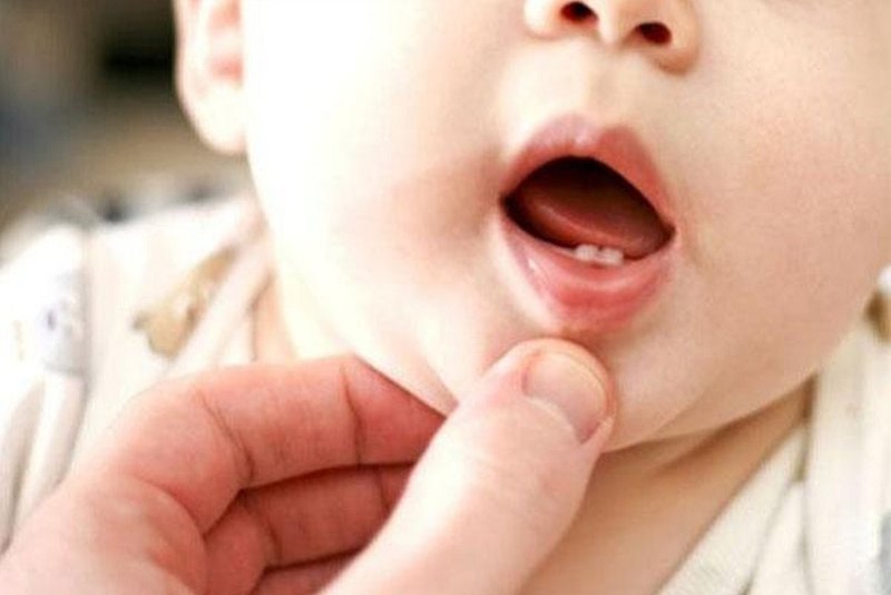Khi trẻ đột nhiên bị sốt, phụ huynh cần xem xét các yếu tố khác để chắc chắn đó là triệu chứng sốt mọc răng