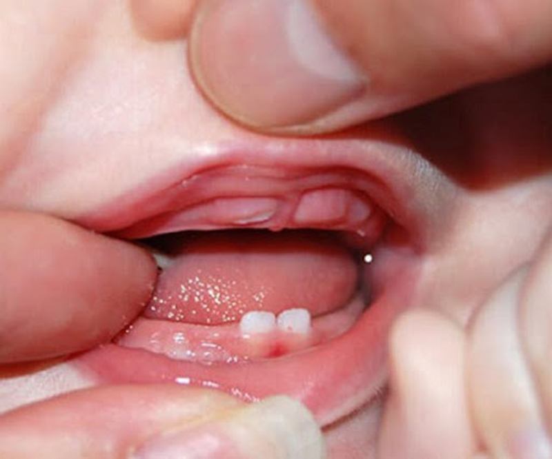 Trong quá trình mọc răng sữa lợi của bé có thể bị sưng đỏ