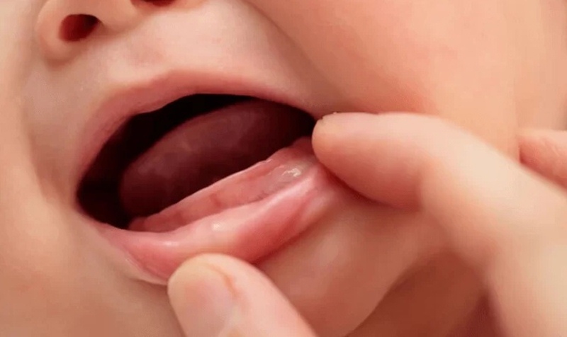 Cha mẹ cần phân biệt trẻ mọc răng sớm và nanh sữa