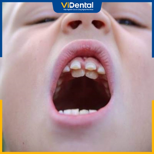 Đôi khi sự xuất hiện của răng thừa còn gây ra một số bệnh lý răng miệng